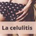 La celulitis
