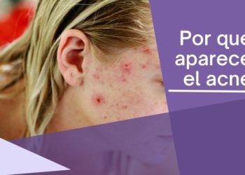 Por qué aparece el acné