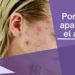 Por qué aparece el acné
