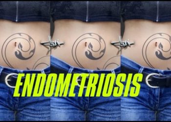 endometriosis