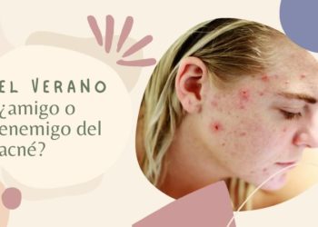 El verano ¿amigo o enemigo del acné?